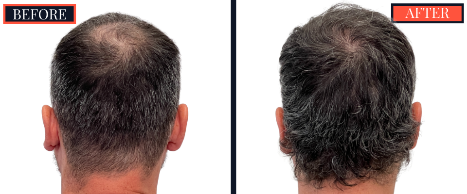 1210 graft FUE hair transplant before and after