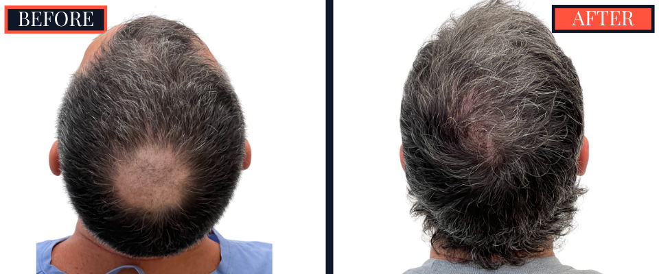 1210 graft FUE hair transplant before and after