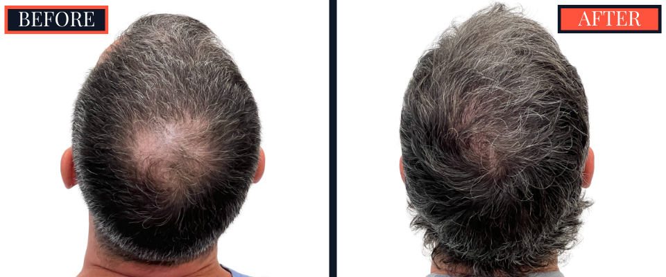 1210 graft FUE hair transplant before and after