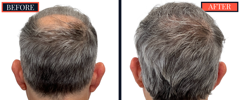 1830 G FUE HAIR TRANSPLANT BEFORE AND AFTER