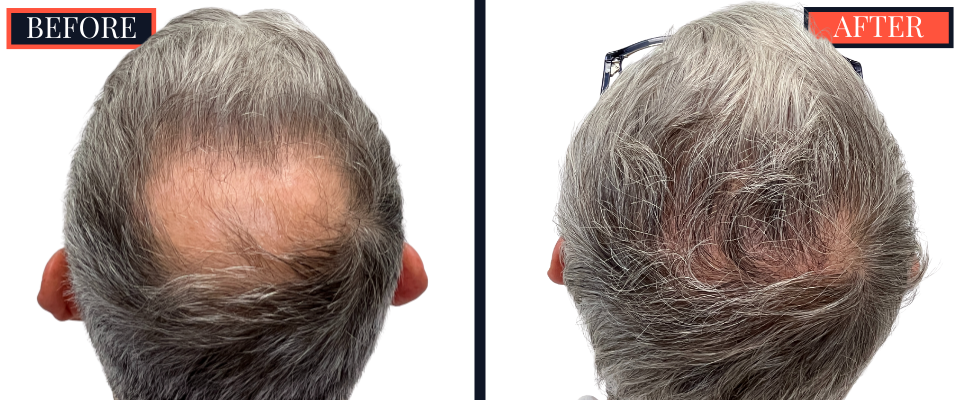 1830 G FUE HAIR TRANSPLANT BEFORE AND AFTER