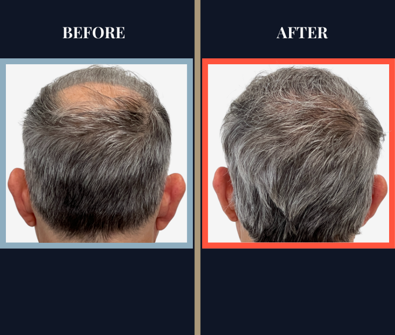 1830 G FUE HAIR TRANSPLANT BEFORE AND AFTER