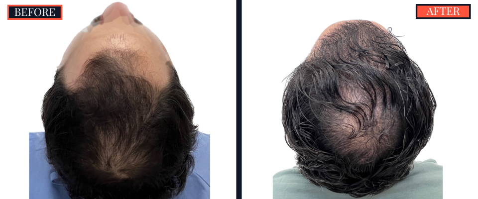 2418 GRAFT FUE HAIR TRANSPLANT SURGERY BEFORE AND AFTER RESULTS