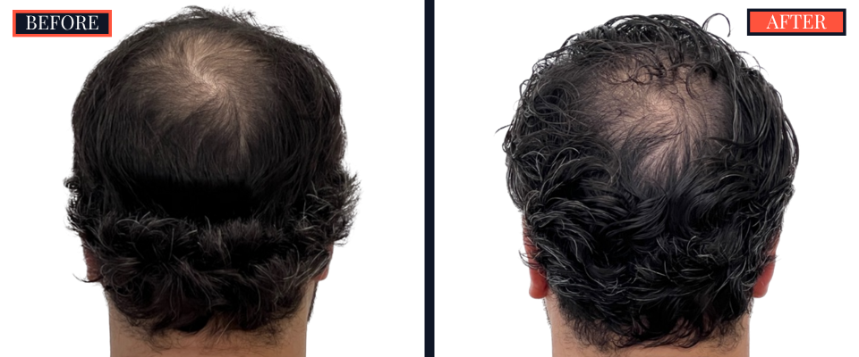 2418 GRAFT FUE HAIR TRANSPLANT SURGERY BEFORE AND AFTER RESULTS