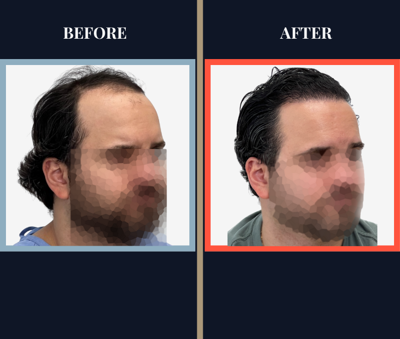 2418 GRAFT FUE HAIR TRANSPLANT SURGERY BEFORE AND AFTER RESULTS