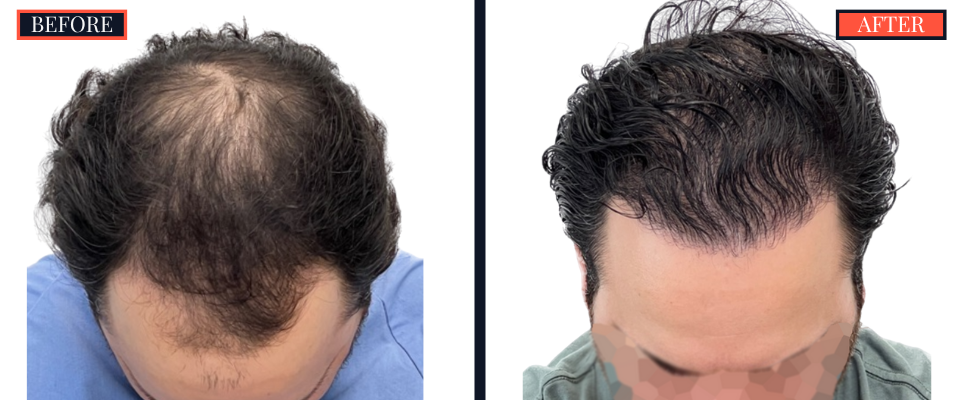 2418 GRAFT FUE HAIR TRANSPLANT SURGERY BEFORE AND AFTER RESULTS