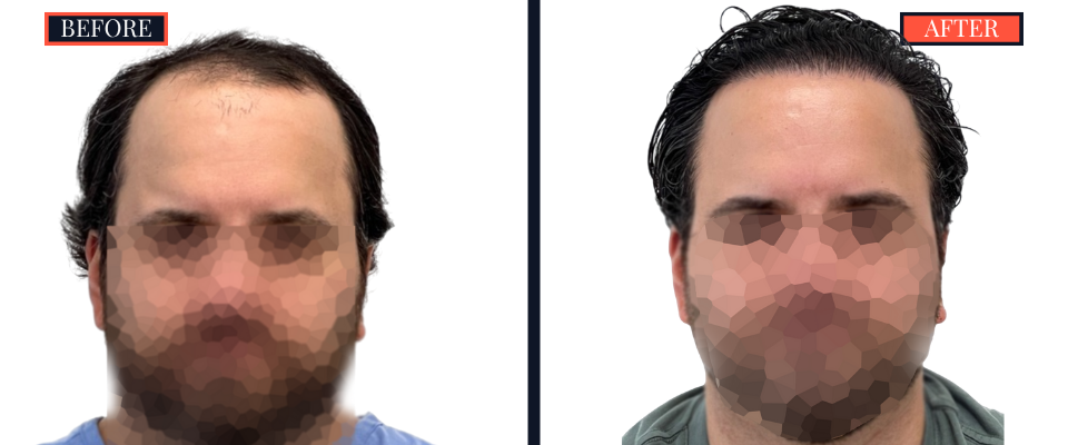2418 GRAFT FUE HAIR TRANSPLANT SURGERY BEFORE AND AFTER RESULTS