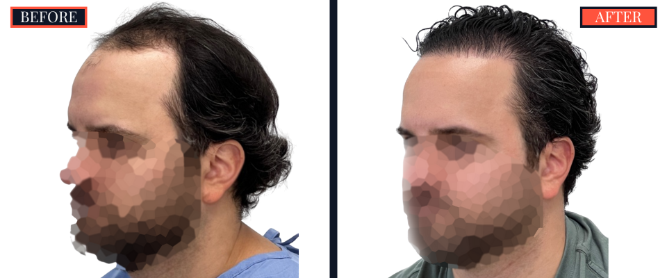 2418 GRAFT FUE HAIR TRANSPLANT SURGERY BEFORE AND AFTER RESULTS