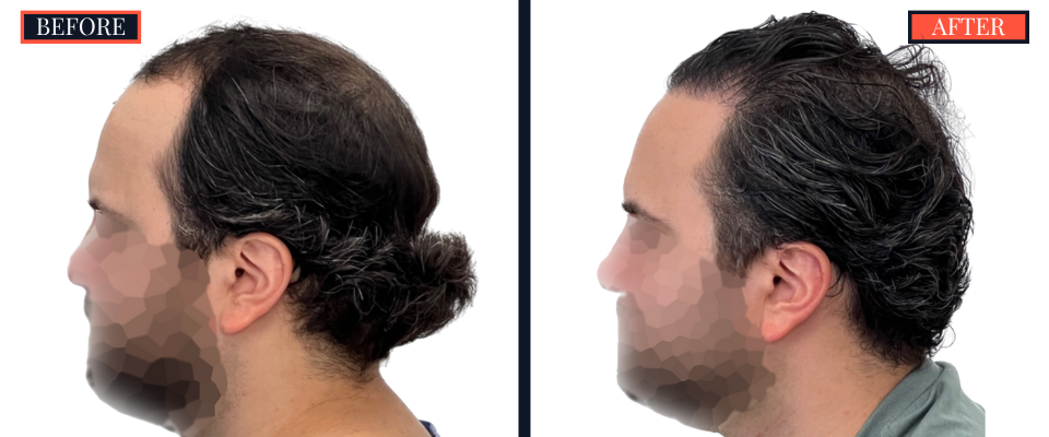 2418 GRAFT FUE HAIR TRANSPLANT SURGERY BEFORE AND AFTER RESULTS