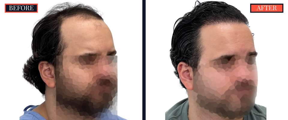 2418 GRAFT FUE HAIR TRANSPLANT SURGERY BEFORE AND AFTER RESULTS