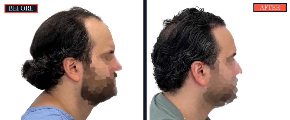 2418 GRAFT FUE HAIR TRANSPLANT SURGERY BEFORE AND AFTER RESULTS