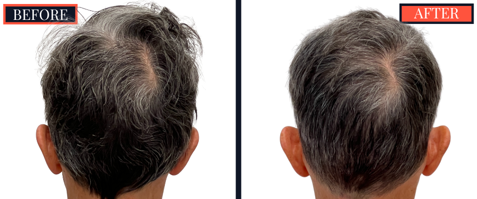 2730 GRAFT FUT STRIP HAIR TRANSPLANT BEFORE AND AFTER