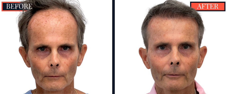 2730 GRAFT FUT STRIP HAIR TRANSPLANT BEFORE AND AFTER
