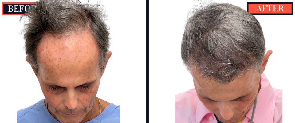 2730 GRAFT FUT STRIP HAIR TRANSPLANT BEFORE AND AFTER
