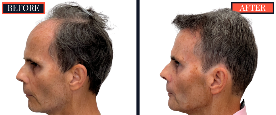 2730 GRAFT FUT STRIP HAIR TRANSPLANT BEFORE AND AFTER
