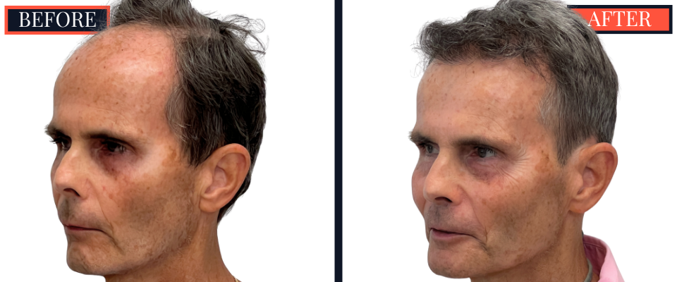 2730 GRAFT FUT STRIP HAIR TRANSPLANT BEFORE AND AFTER