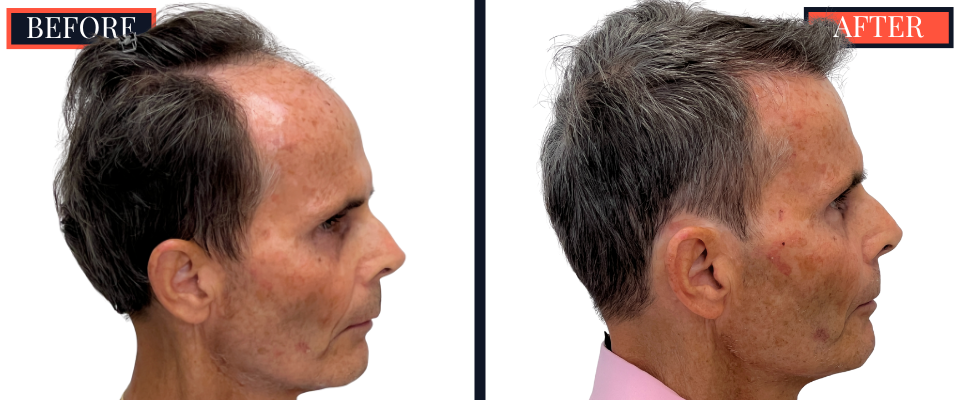 2730 GRAFT FUT STRIP HAIR TRANSPLANT BEFORE AND AFTER