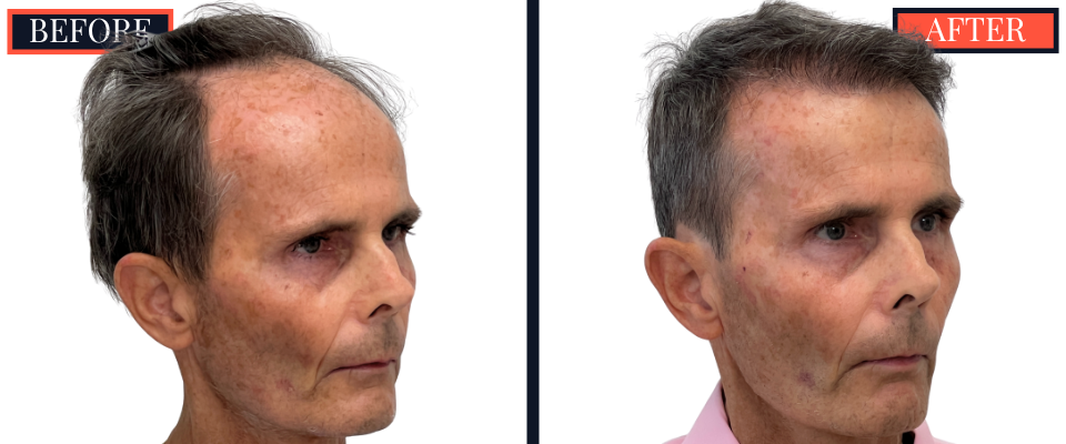 2730 GRAFT FUT STRIP HAIR TRANSPLANT BEFORE AND AFTER