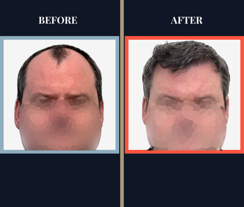 2354 GRAFT FUE HAIR TRANSPLANT - 1 YEAR POST-OP RESULTS