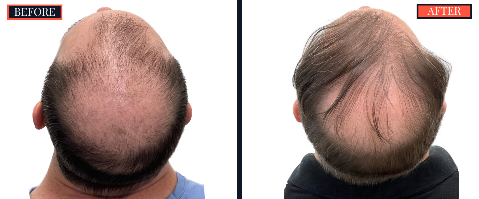 2158 GRAFT FUE HAIR TRANSPLANT - BEFORE AND AFTER