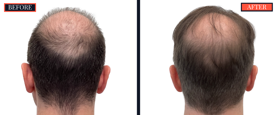2158 GRAFT FUE HAIR TRANSPLANT - BEFORE AND AFTER