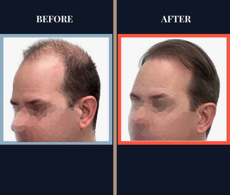 2158 GRAFT FUE HAIR TRANSPLANT - BEFORE AND AFTER