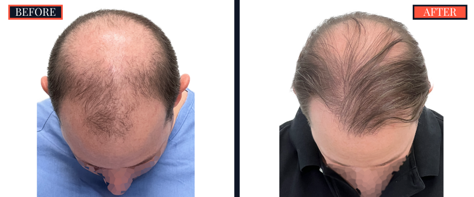 2158 GRAFT FUE HAIR TRANSPLANT - BEFORE AND AFTER