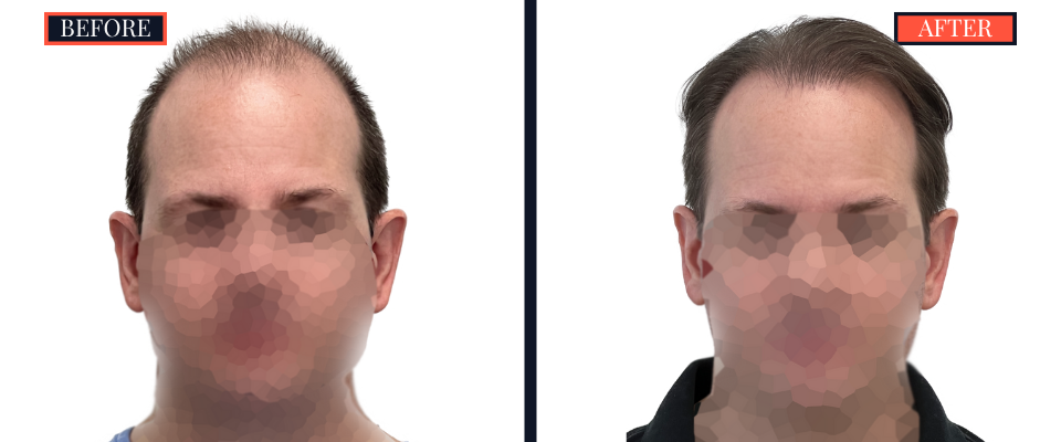 2158 GRAFT FUE HAIR TRANSPLANT - BEFORE AND AFTER