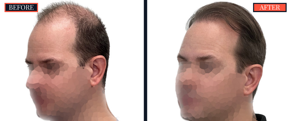 2158 GRAFT FUE HAIR TRANSPLANT - BEFORE AND AFTER