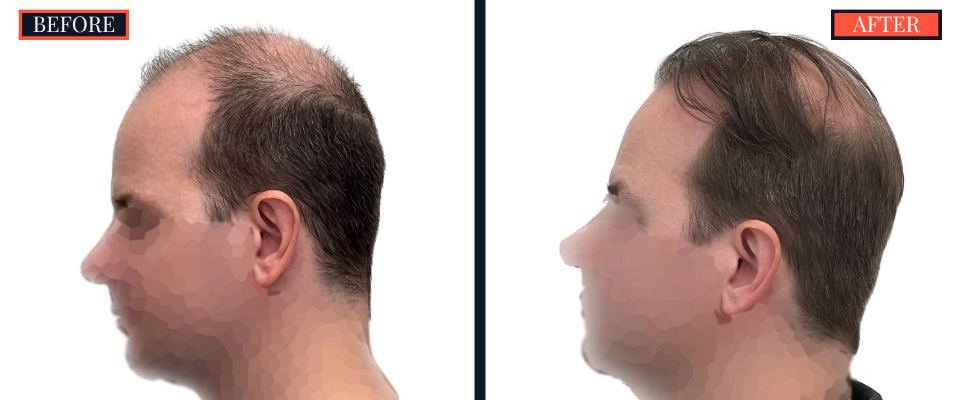 2158 GRAFT FUE HAIR TRANSPLANT - BEFORE AND AFTER