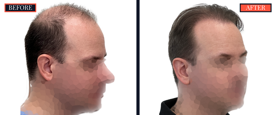 2158 GRAFT FUE HAIR TRANSPLANT - BEFORE AND AFTER
