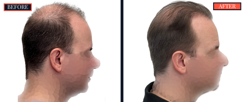 2158 GRAFT FUE HAIR TRANSPLANT - BEFORE AND AFTER