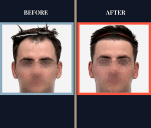 1812 G FUE HAIR TRANSPLANT BEFORE AND AFTER RESULTS