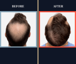 FUE Hair Transplant - 2593 grafts - Before and After Results