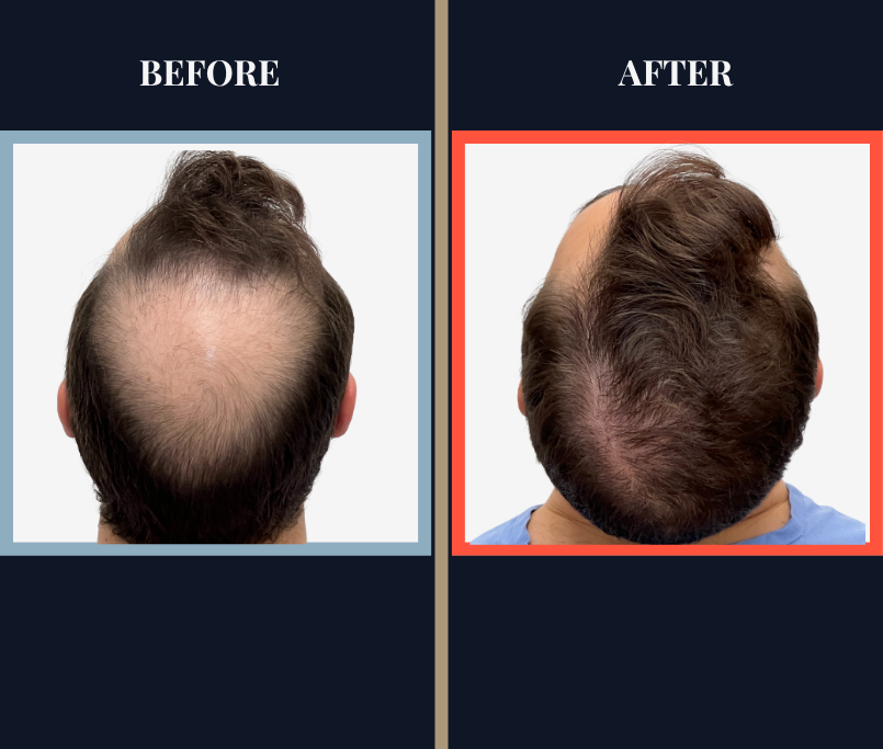 FUE Hair Transplant - 2593 grafts - Before and After Results