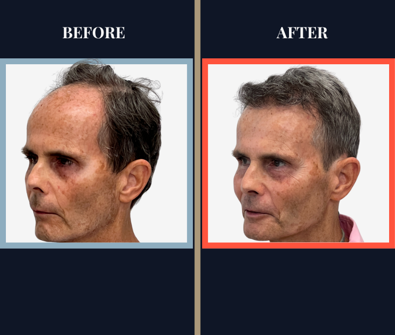 2730 GRAFT FUT STRIP HAIR TRANSPLANT BEFORE AND AFTER