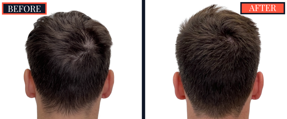 1812 G FUE HAIR TRANSPLANT BEFORE AND AFTER RESULTS