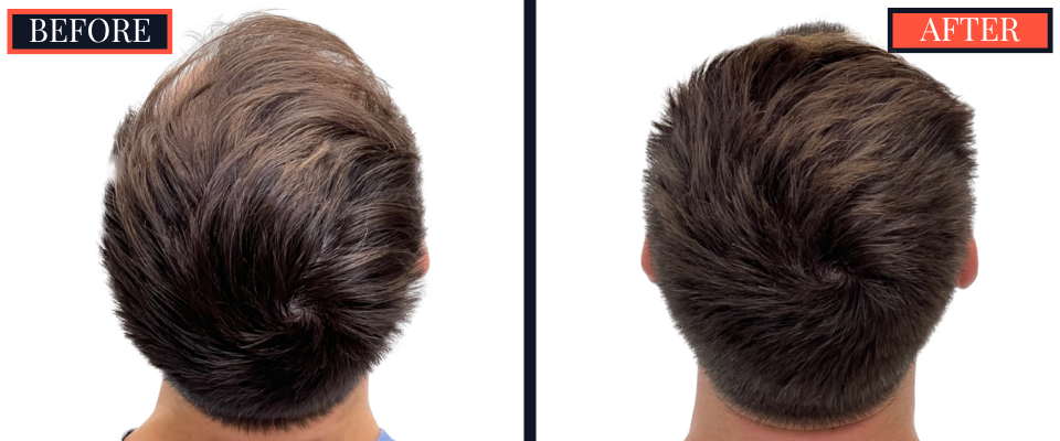 1812 G FUE HAIR TRANSPLANT BEFORE AND AFTER RESULTS
