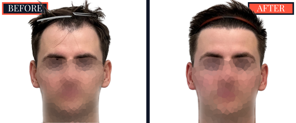 1812 G FUE HAIR TRANSPLANT BEFORE AND AFTER RESULTS