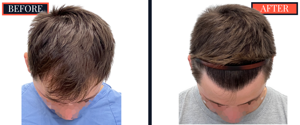 1812 G FUE HAIR TRANSPLANT BEFORE AND AFTER RESULTS