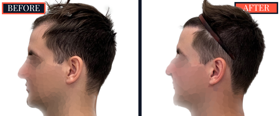 1812 G FUE HAIR TRANSPLANT BEFORE AND AFTER RESULTS