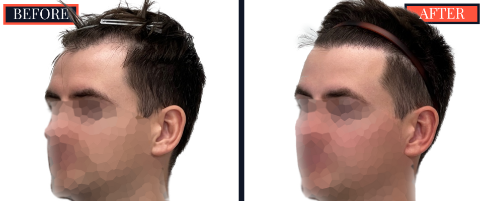 1812 G FUE HAIR TRANSPLANT BEFORE AND AFTER RESULTS