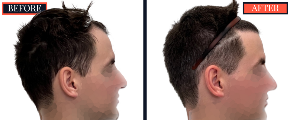 1812 G FUE HAIR TRANSPLANT BEFORE AND AFTER RESULTS