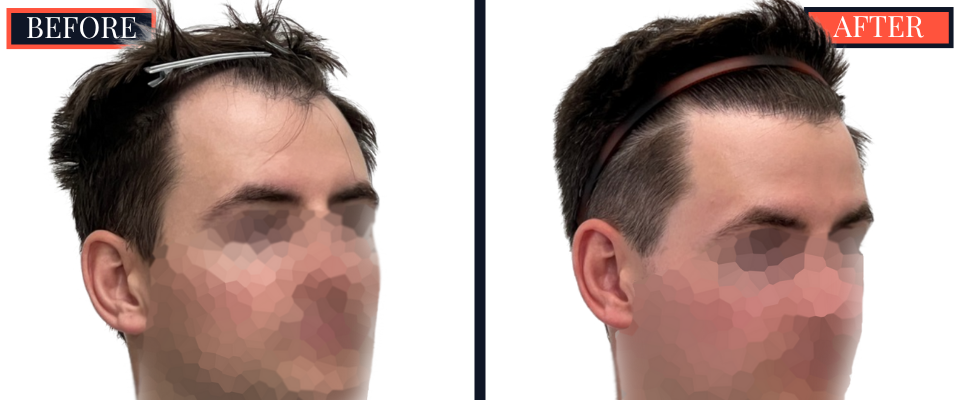 1812 G FUE HAIR TRANSPLANT BEFORE AND AFTER RESULTS