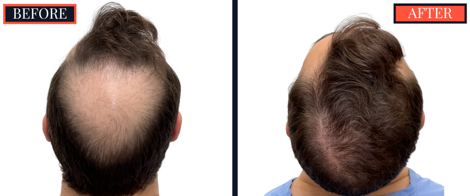FUE Hair Transplant - 2593 grafts - Before and After Results