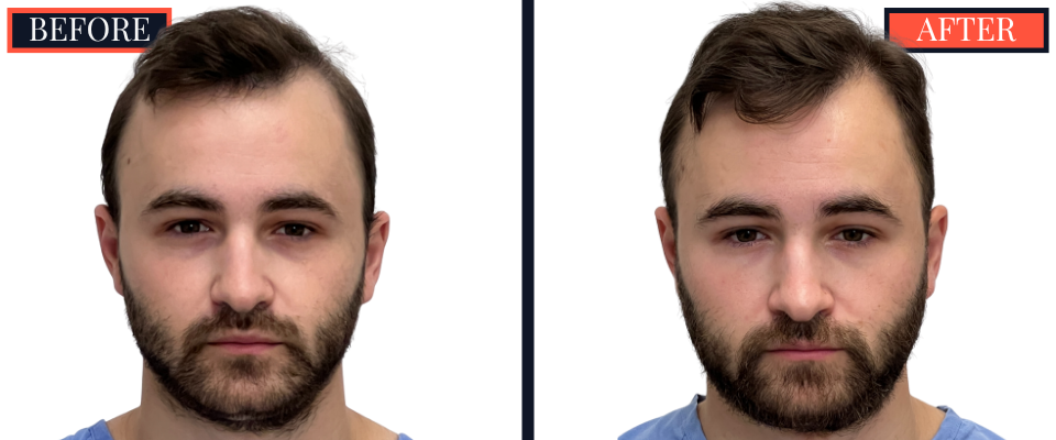 FUE Hair Transplant - 2593 grafts - Before and After Results