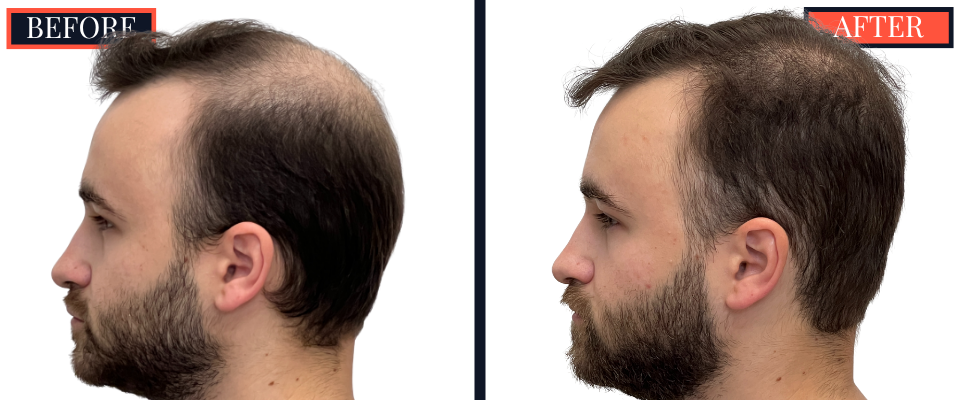 FUE Hair Transplant - 2593 grafts - Before and After Results