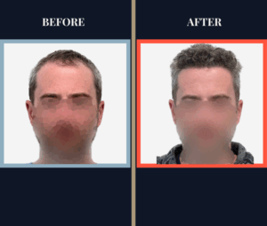 FUE Hair Transplant - 1773 grafts