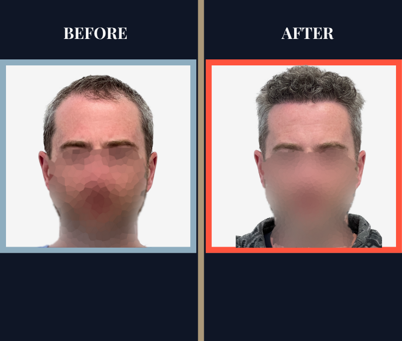 FUE Hair Transplant - 1773 grafts