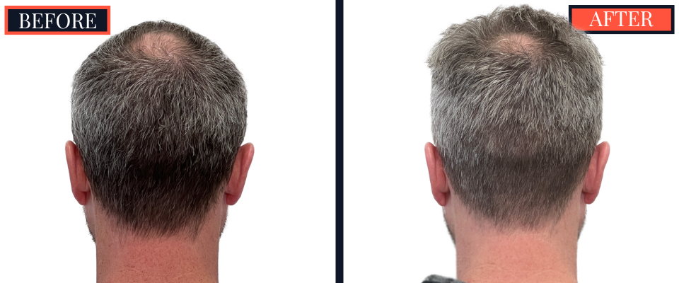 FUE Hair Transplant - 1773 grafts